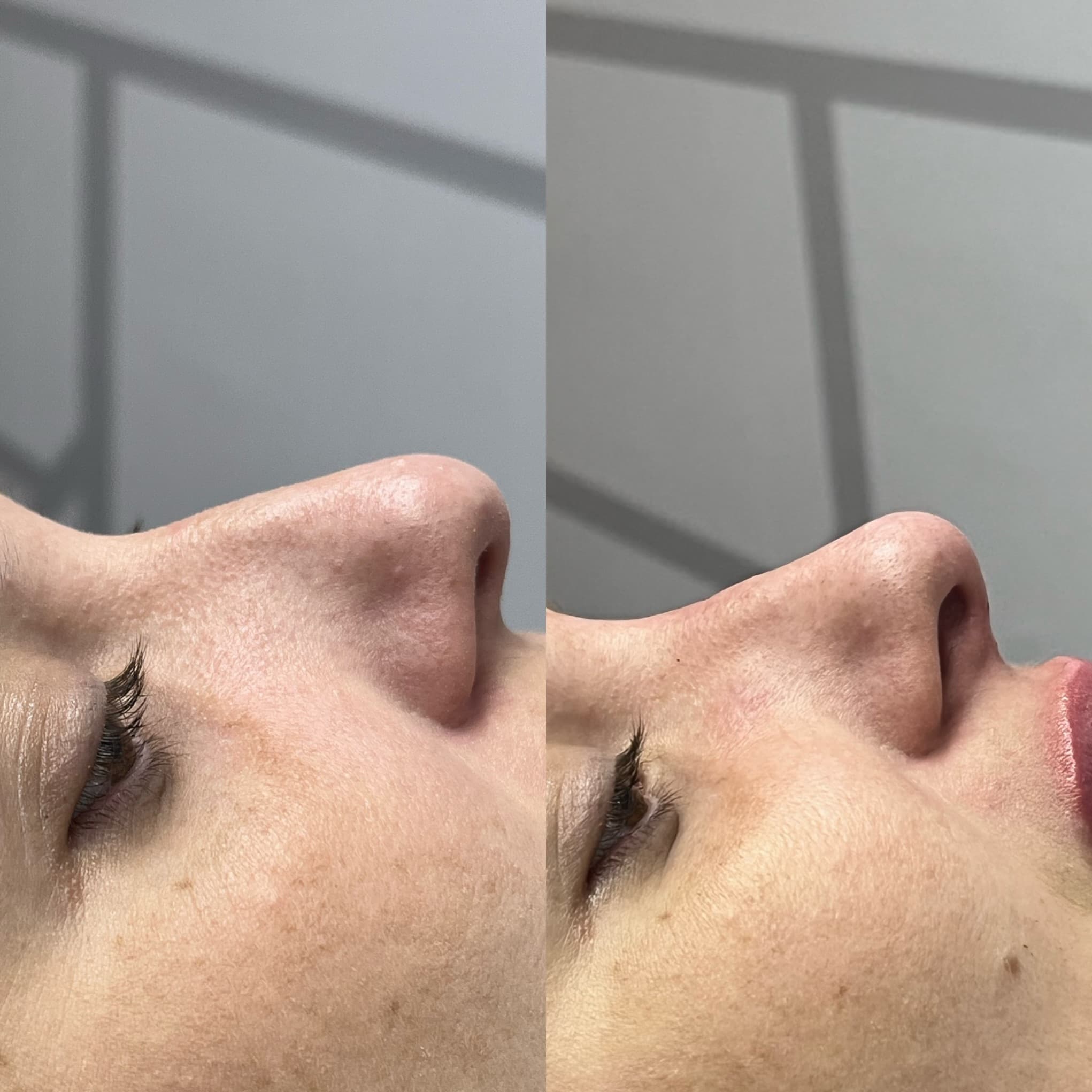 Comparativo de diagnóstico e conclusão de harmonização do perfil facial